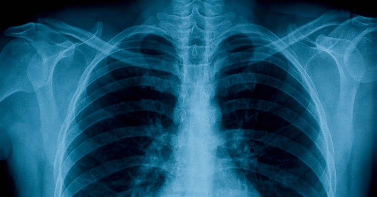 Transient Tachypnea of the Newborn: Causes, Symptoms, and Treatment